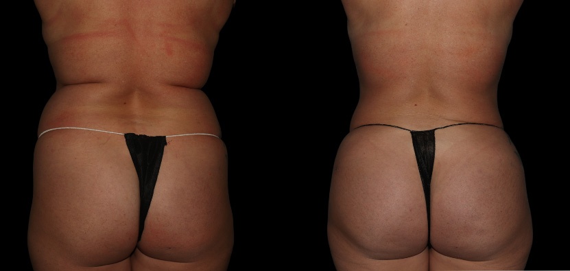 BBL Before After Surgery Recovery Perfect Thighs