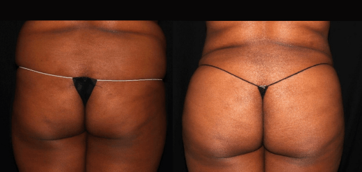 Brazilian Butt Lift Before & After Philly