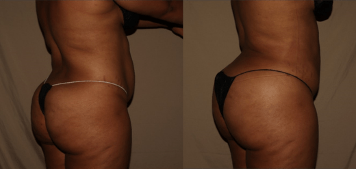 Butt Lift before and after