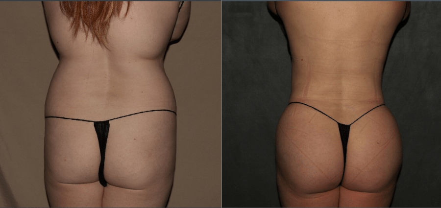 Butt Lift before and after