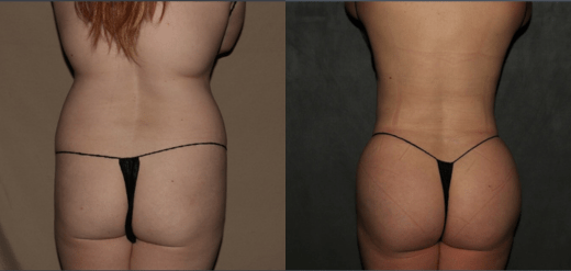 Butt Lift before and after